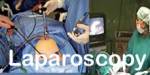 LAPAROSCOPY FOR INFERTILITY TREATMENT