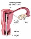 NEW TECHNIQUES IN IVF 