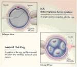 ICSI Treatment in India – Process, Treatment and Cost in India