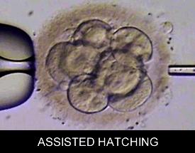 IVF and Assisted Hatching in Surat