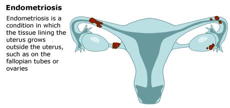 Endometriosis, fertility & pregnancy