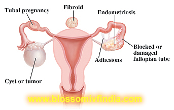 Getting pregnant with blocked fallopian tube